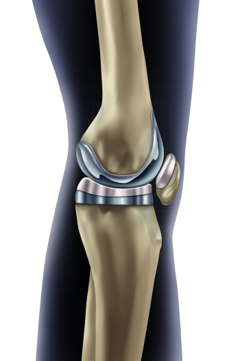 Knee prothesis
