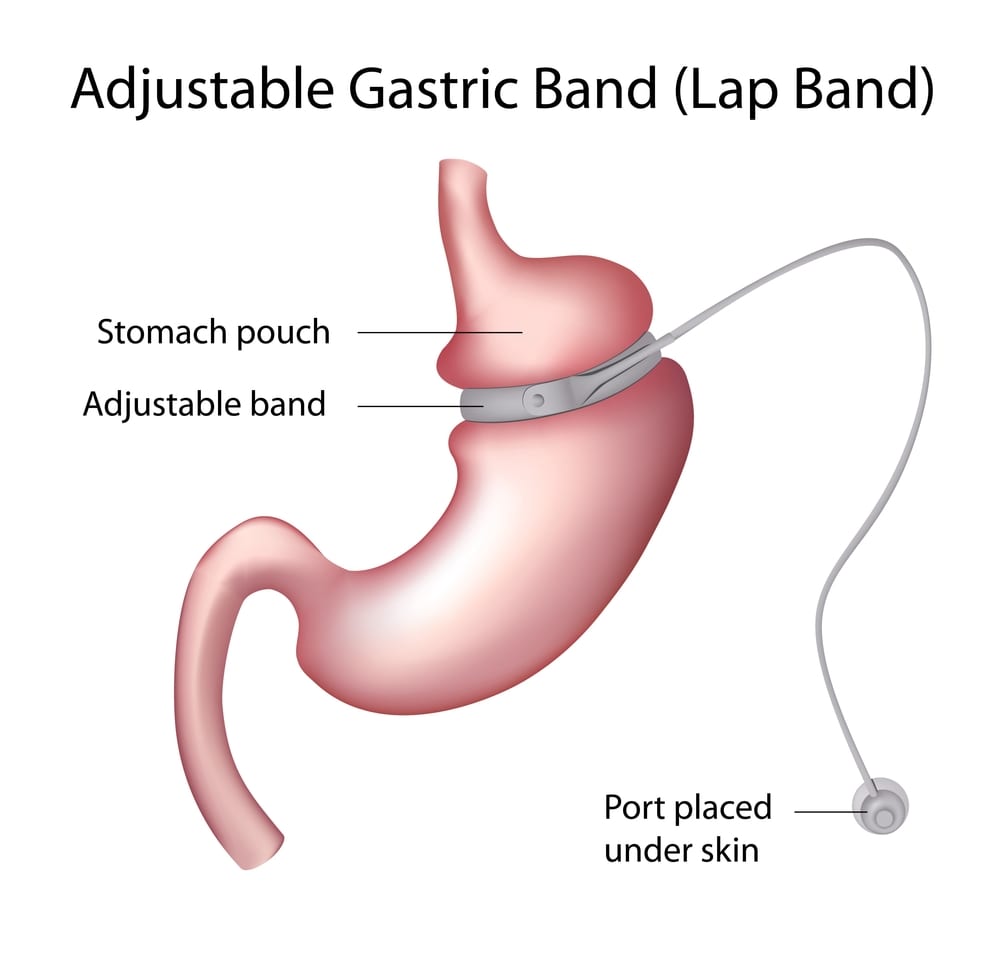 La gastroplastie