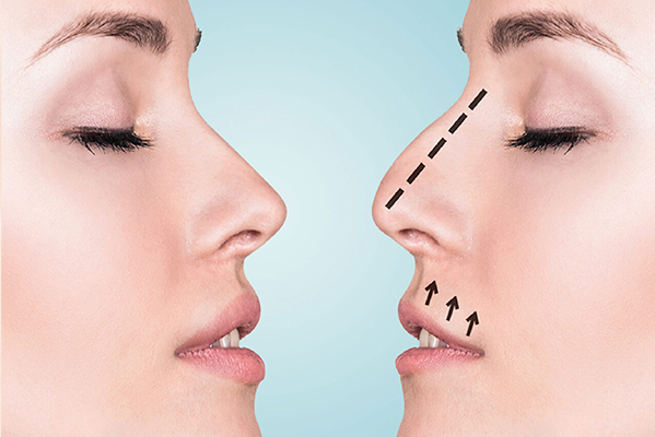 Rhinoplastie