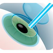 lasik-3