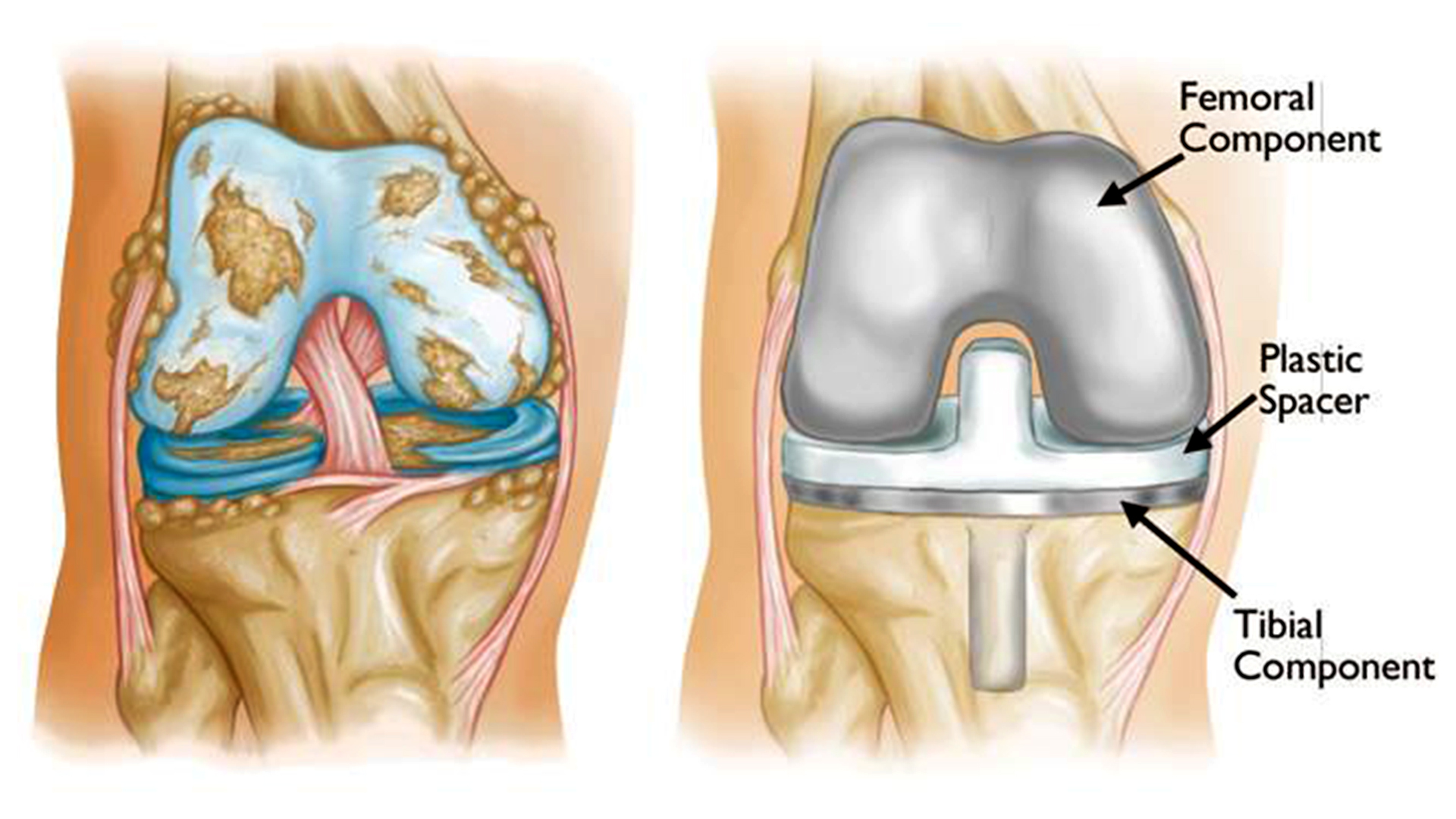 Knee replacement görseli