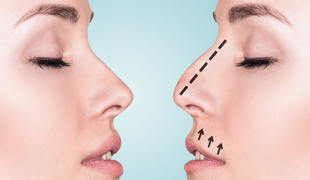 Rhinoplasty