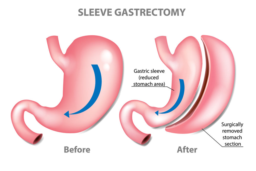 Sleeve gastrectomy