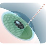 lasik-1 Excimer laser görseli