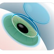 lasik-2 Excimer laser görseli